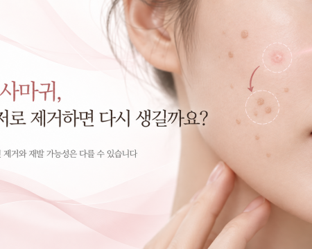 편평사마귀 레이저 제거와 재발 가능성을 설명하는 이미지