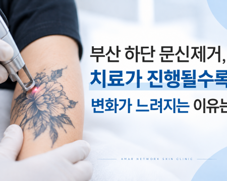 부산 하단 문신제거, 팔 문신에 레이저 시술을 진행하는 모습과 치료가 진행될수록 변화가 느려지는 이유를 설명하는 이미지