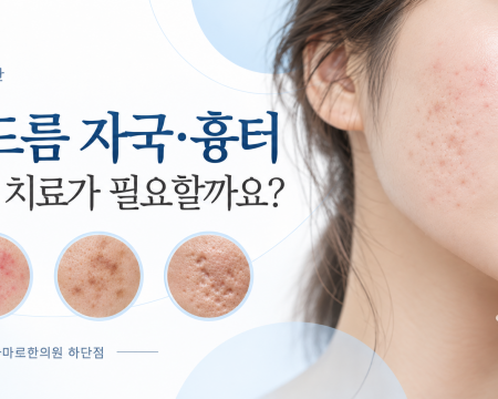부산 하단 여드름 자국·흉터 치료 안내, 붉은 자국 갈색 색소침착 패인 여드름 흉터 예시