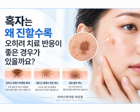 진한 흑자와 피부 색소의 깊이, 경계에 따른 치료 접근을 설명하는 이미지