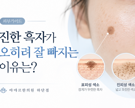 진한 흑자가 표피 쪽에 색소가 집중된 얕은 병변일 경우 비교적 빠르게 반응할 수 있는 이유와 흑자와 기미의 차이를 설명한 아마르한의원 하단점 피부가이드
